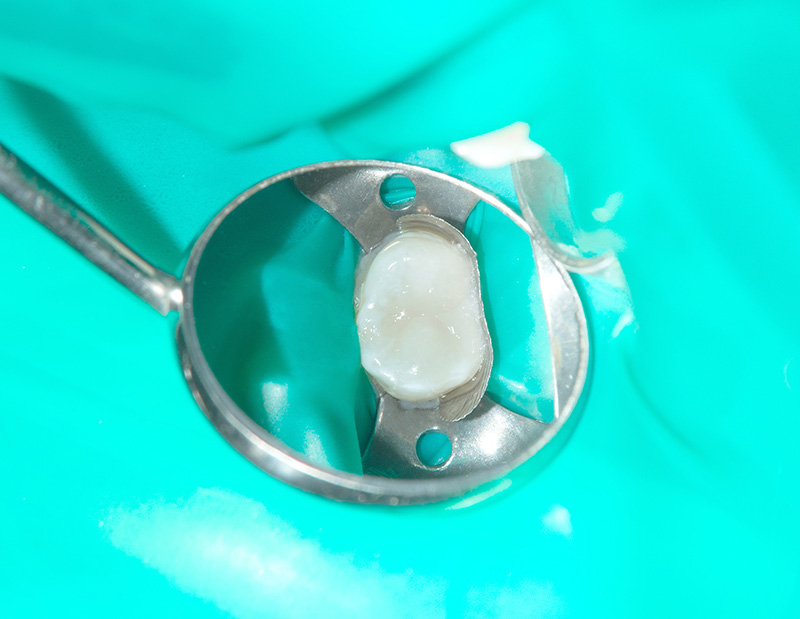 ラバーダムを使う目的