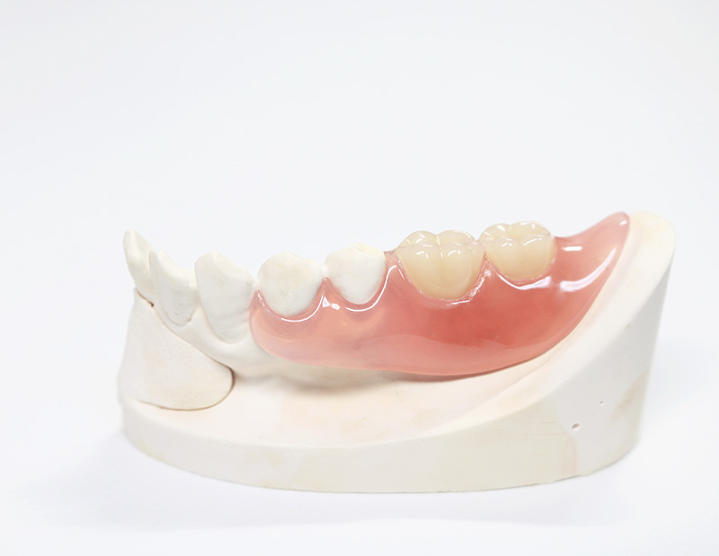 ノンクラスプデンチャー