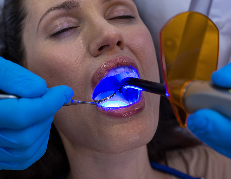 ダイレクトボンディング